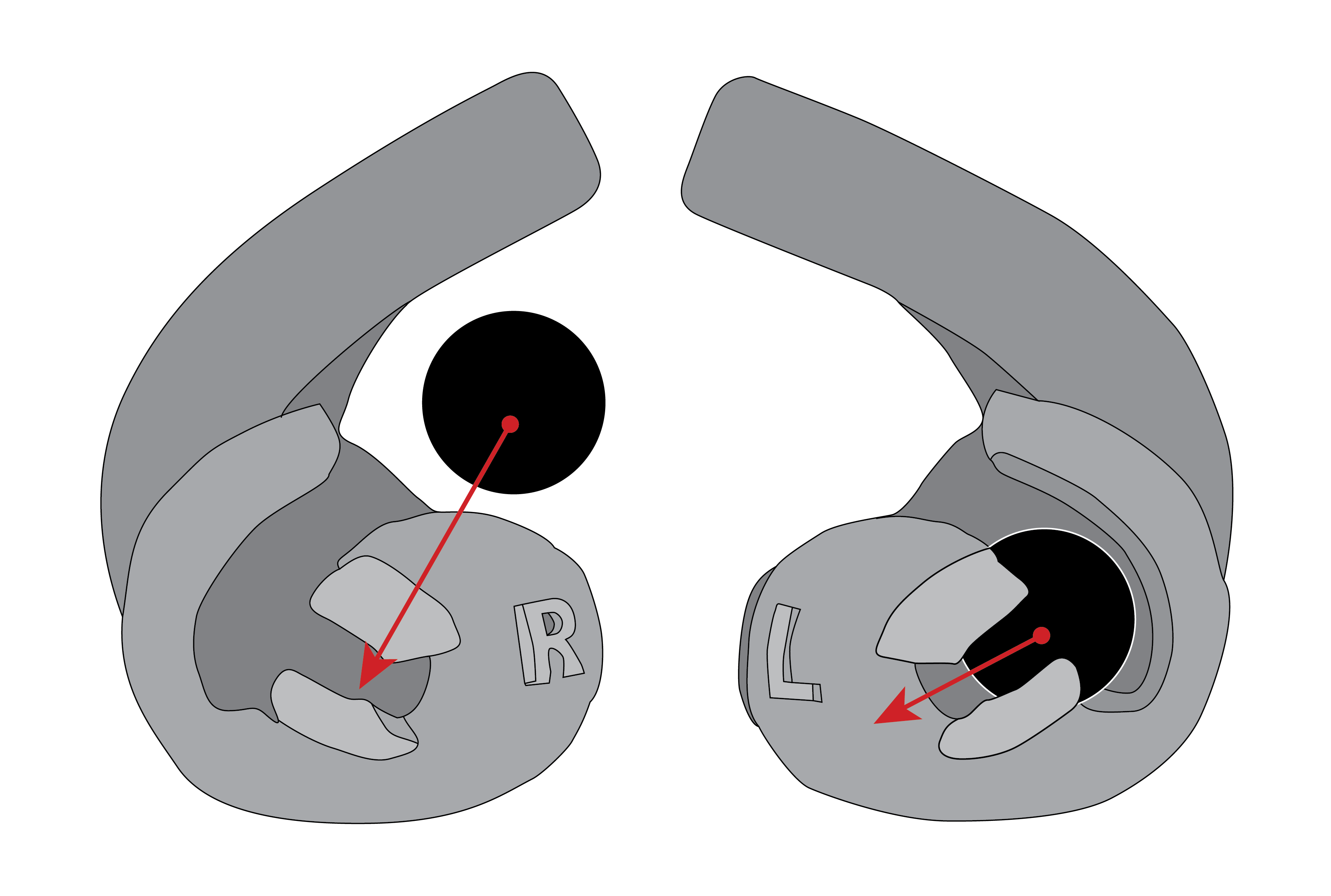 Diagram of Internal Ear retainers with sponge wind guard insertion process